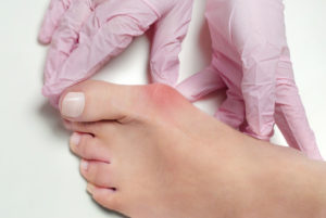 bunion surgery